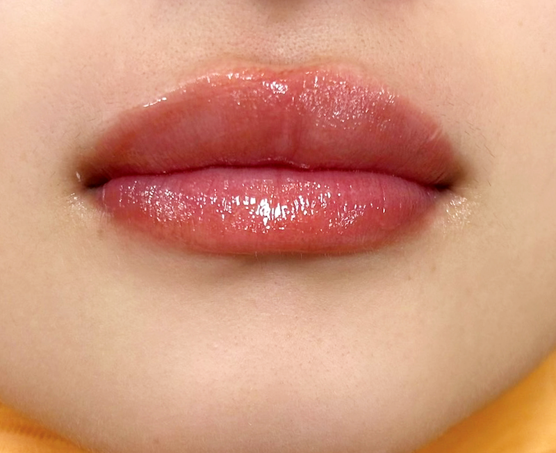 症例のアフター画像