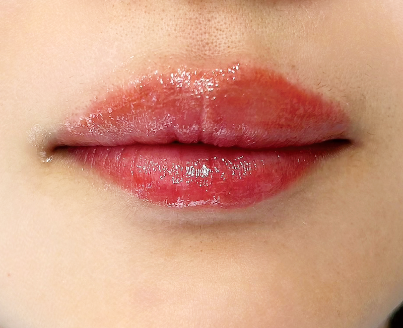 症例のアフター画像