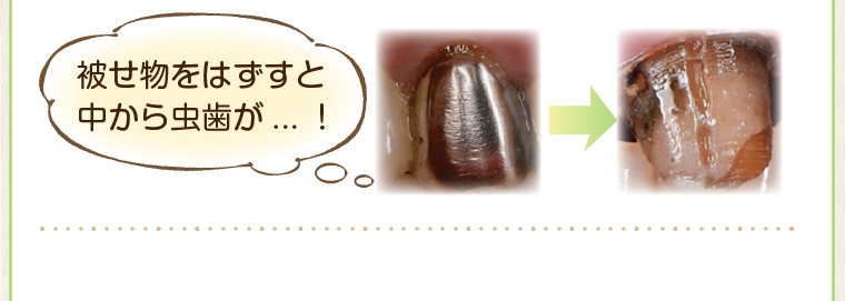 「CEREC(セレック)」を使った審美歯科治療