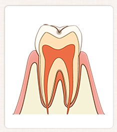 C0：初期段階の虫歯