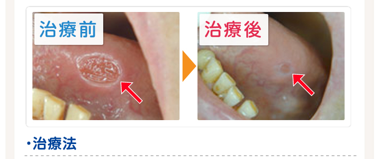 歯茎 腫れ 自然 に 治る