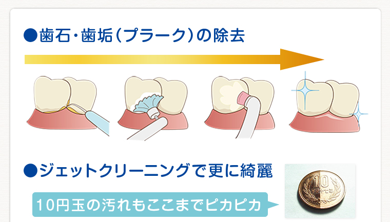 歯石・歯垢(プラーク)の除去のイメージ