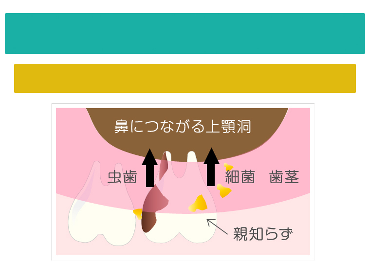 親知らずの最適な治療方法をご紹介 大阪羽曳野市の加藤歯科 親知らずの最適な治療方法をご紹介 大阪羽曳野市の加藤歯科