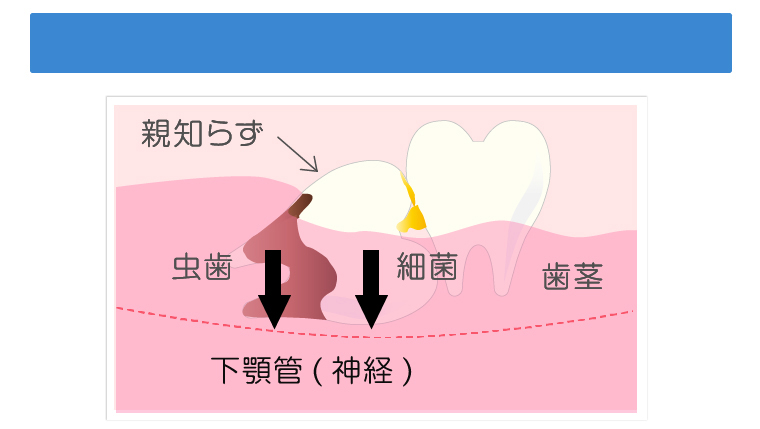 親知らずの最適な治療方法をご紹介 大阪羽曳野市の加藤歯科 親知らずの最適な治療方法をご紹介 大阪羽曳野市の加藤歯科
