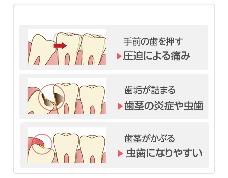 親知らずによる痛み　桜新町　歯医者