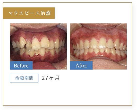 CASE3 施術前・施術後