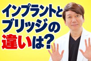 インプラントとブリッジの違いは？