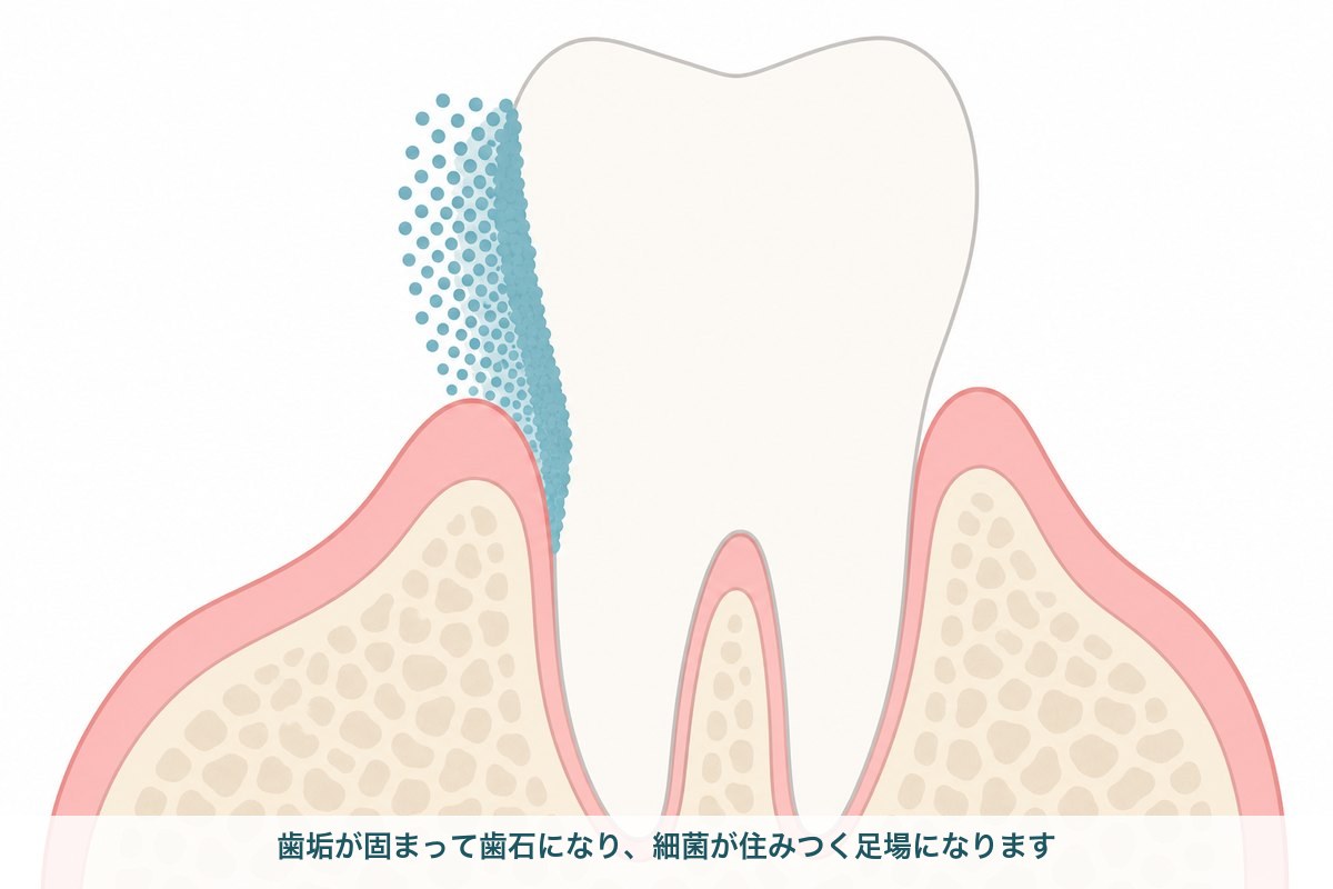 歯と歯ぐきの境目に付いた歯垢が、硬い歯石になっていくようすを1枚の断面で示した模式図